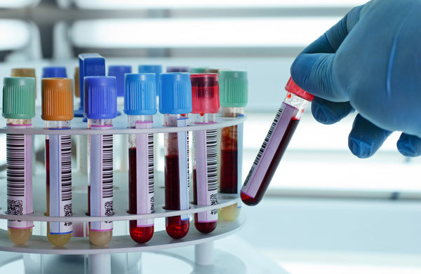 Médecine – Avancée extraordinaire : une seule prise de sang pour un dépistage précoce de 8 types de Cancer.