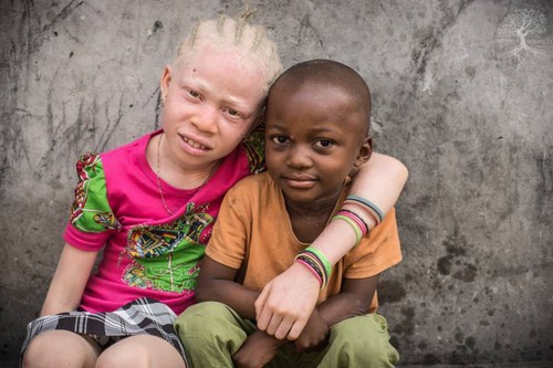Le saviez-vous ? Au Mali, on tue et on ampute des petites filles Albinos